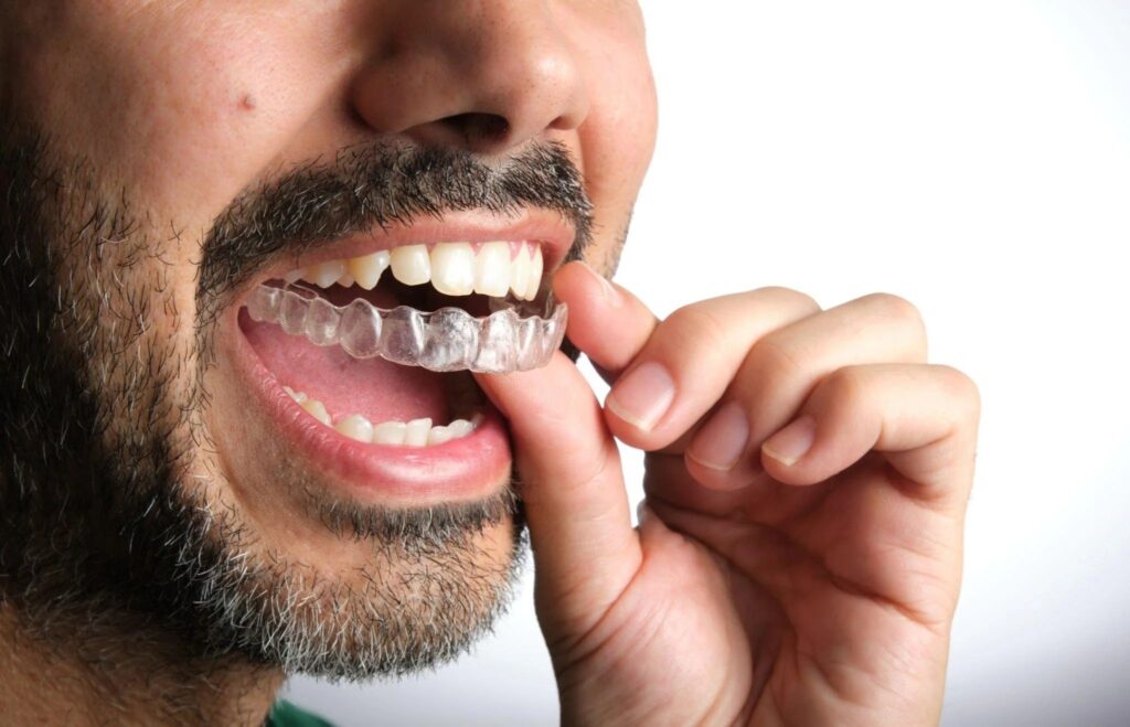 dental invisalign treatment