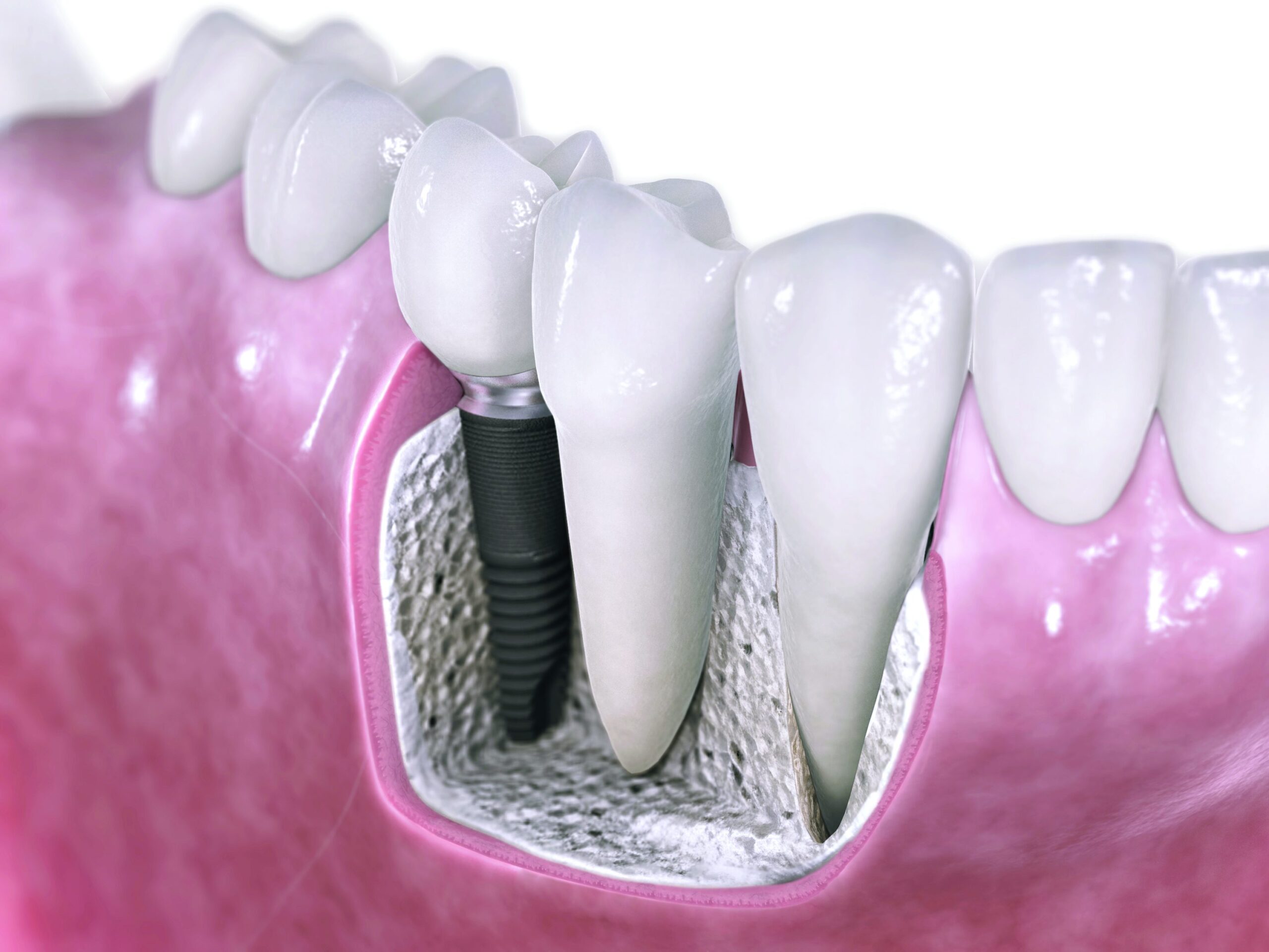 Dental Implants in Encino
