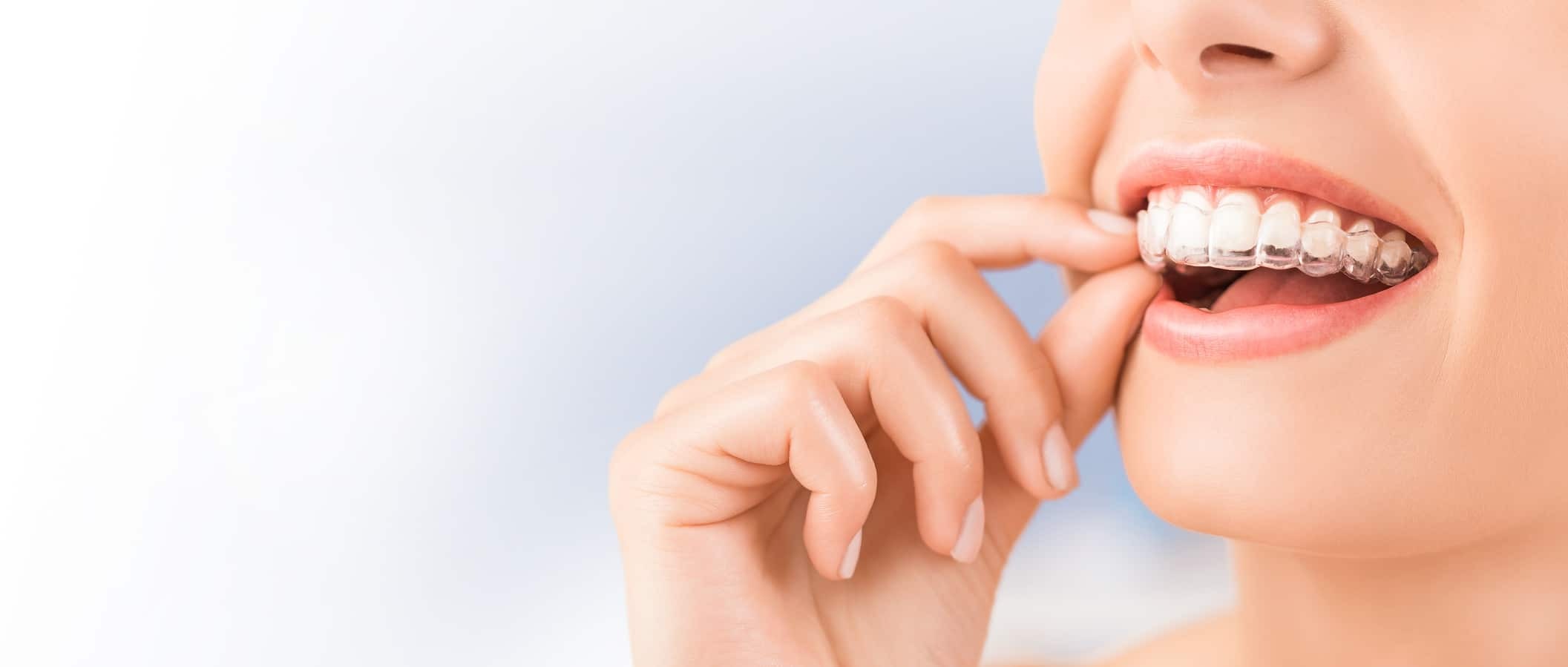 dental invisalign treatment