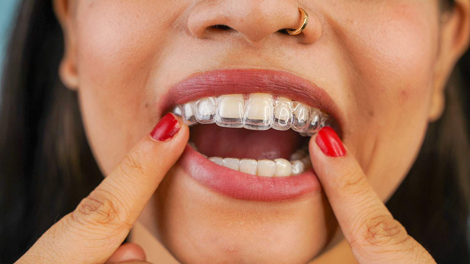 Invisalign in Agoura Hills